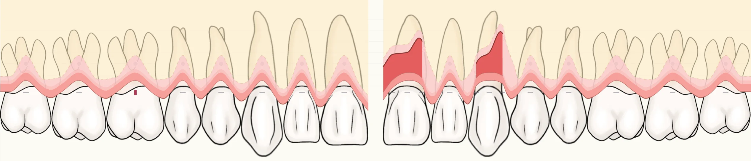 Real DentiPlan gum chart for the upper teeth, with probing depths per site and pockets drawn on tooth outlines.